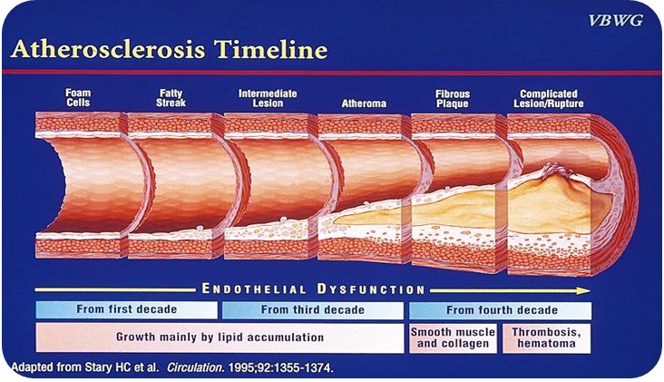 risk-for-atherosclerosis-itamar-medical