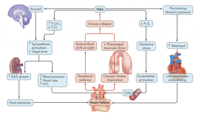 The Complex Interaction Between Heart Failure and OSA - Itamar Medical